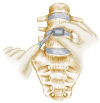 Anterior Lumbar Interbody