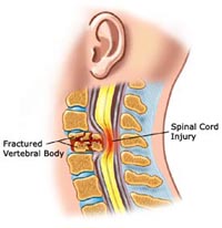 spinal-cord-injury1