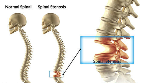 spinal stenosis treatment India