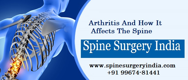 Arthritis and how it affects the Spine