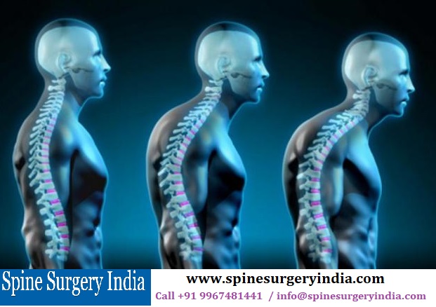 Kyphosis Surgery in India