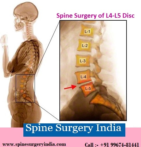 spine surgery of L4-L5 disc in India