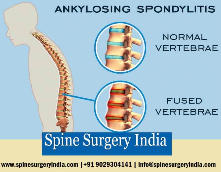 Ankylosing Spondylitis in India