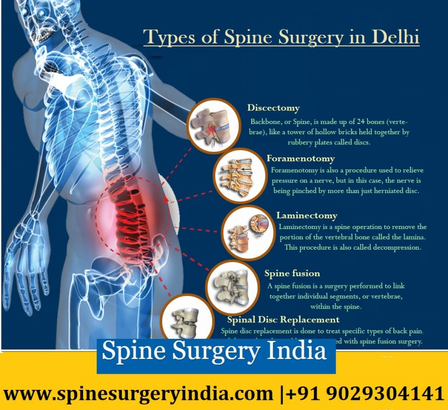 spine surgery in delhi