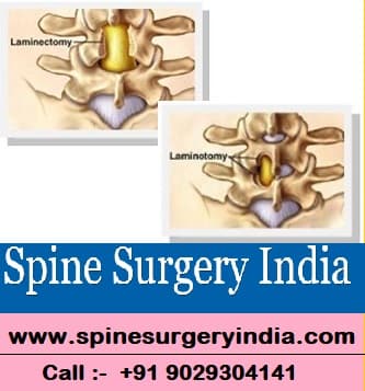 difference between laminotomy and laminectomy