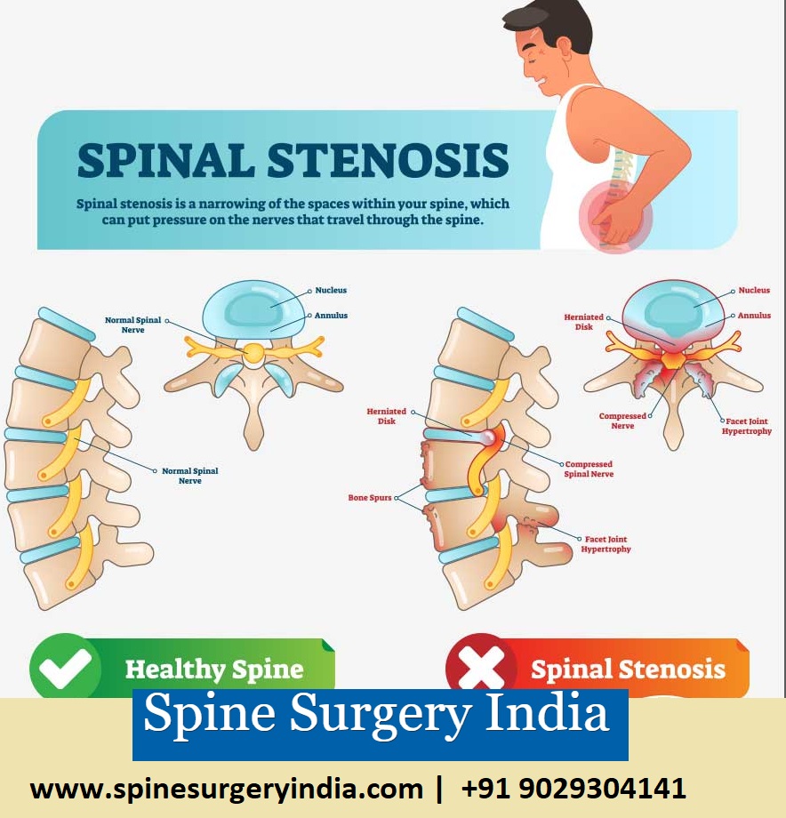 Spinal Stenosis Treatment in India