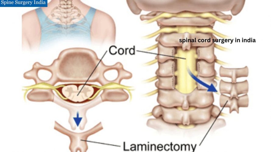 spinal cord surgery in india