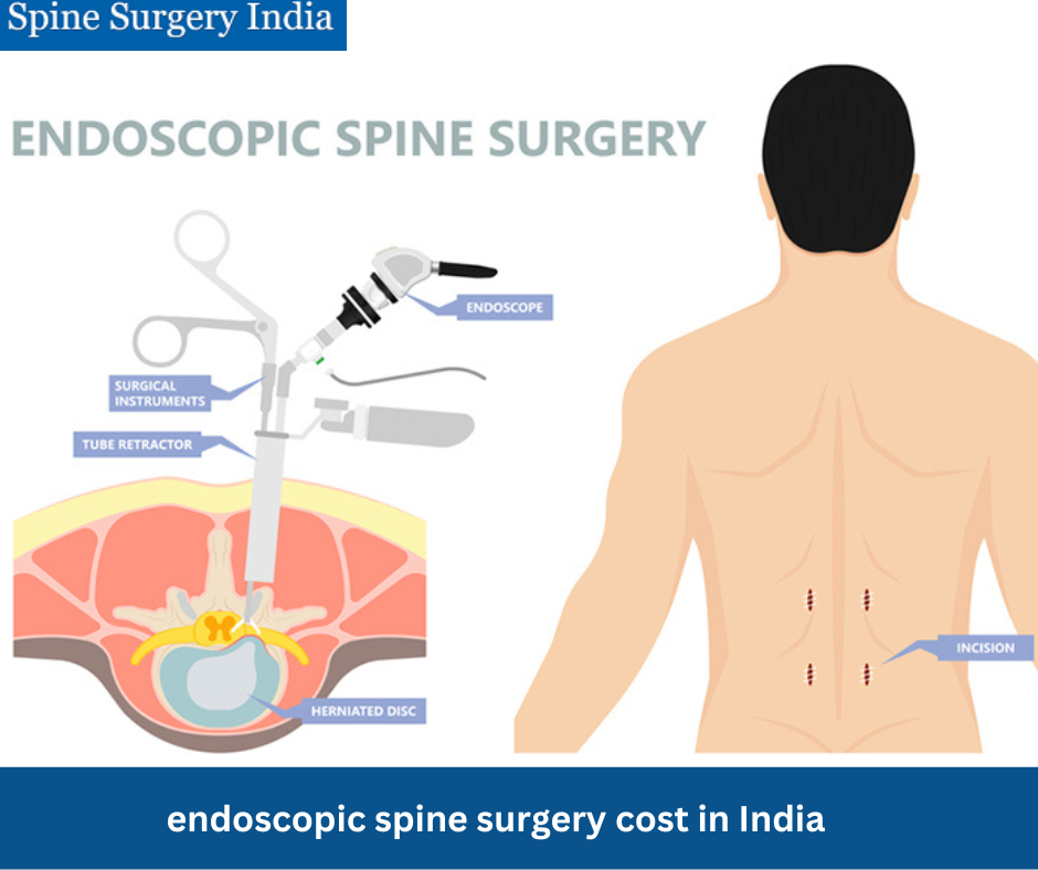 endoscopic spine surgery cost India